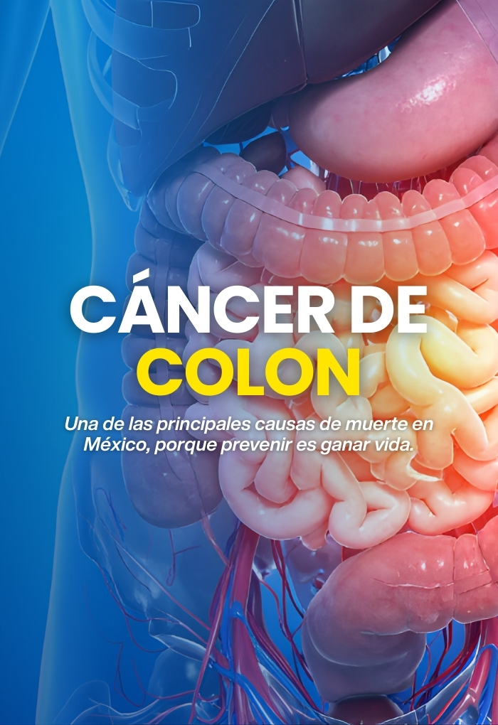 Prevención y detección de cáncer de colon en CDMX